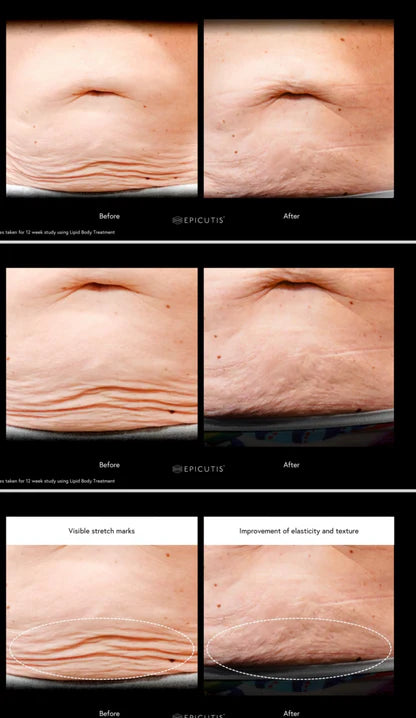 Lipid Body Treatment