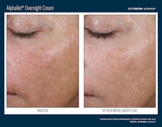 AlphaRet Overnight Cream