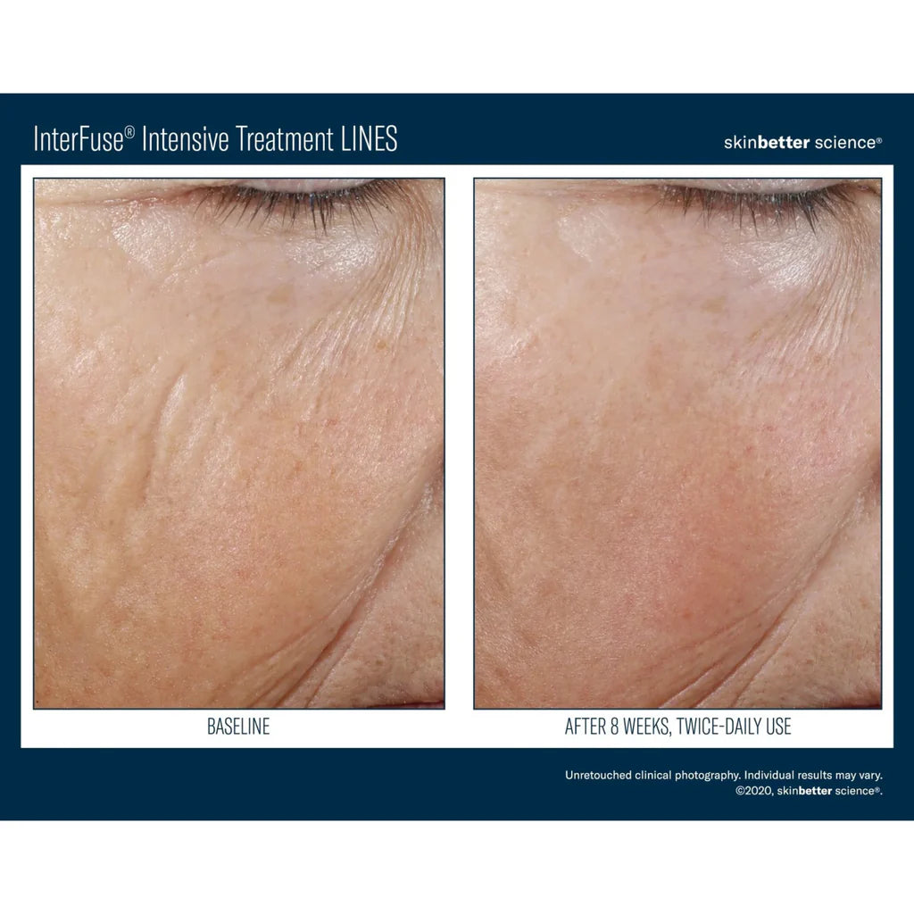 InterFuse Intensive Treatment LINES